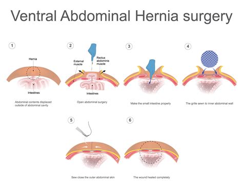 lv lhr|ventral hernia repair procedure steps.